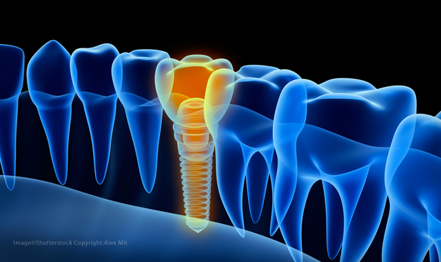New discovery could reduce the dental implant failure rate
