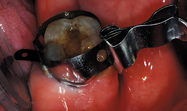 A matrix band was placed to aid in containing the composite when placed and developing the desired anatomy on the mesial.
