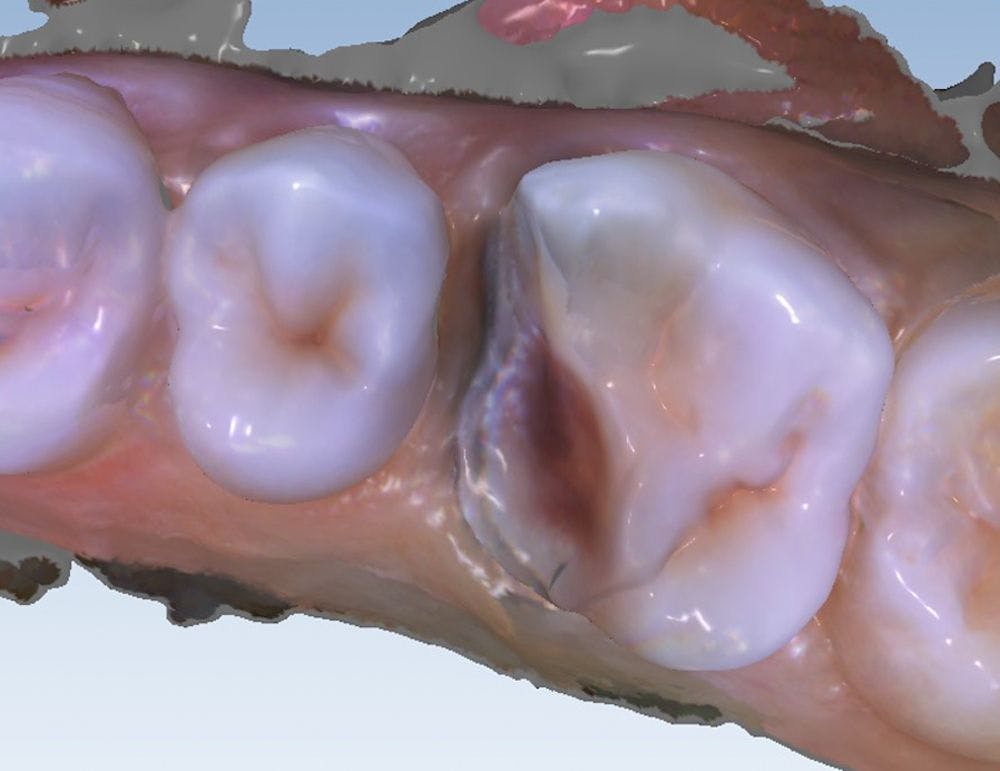 intraoral scanners result in great impressions