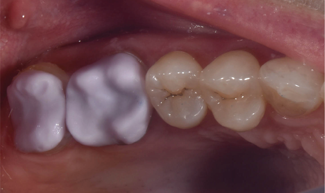 How to complete same-day restorations using intraoral scanning