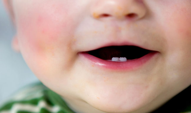 Study finds that yeast-bacteria interaction may be causing tooth decay in toddlers