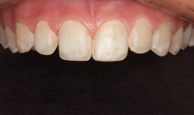 Retracted facial view of prepared teeth
