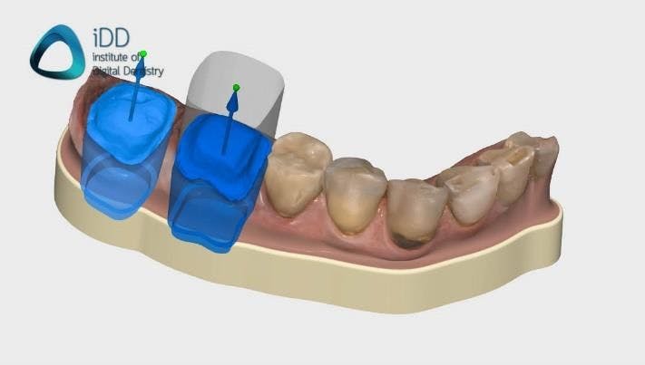 How to Use Medit, exocad to Produce  IPS e.max Crowns In-House for a Single-Visit Workflow