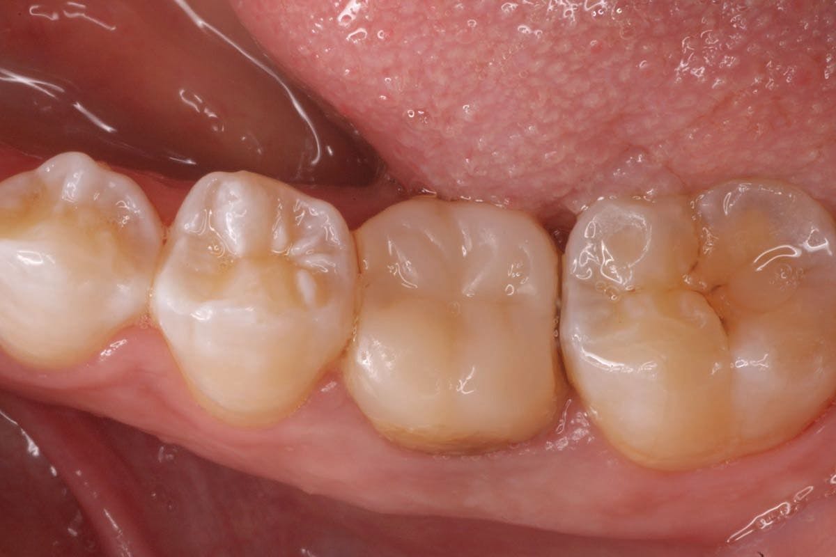 How to Restore “Unrestorable” Teeth | Image Credit: © John Gammichia, DMD, FAGD
